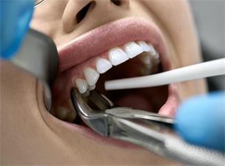 cómo elegir el juego de fórceps de extracción de dientes adecuado